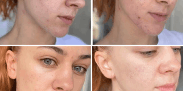 Dermapen Iskrena Recenzija i Iskustva: Je li Vrijedan Tretman za Pomlađivanje Kože?